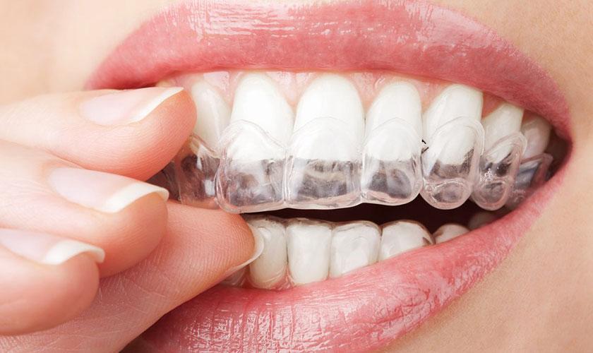 Niềng răng Invisalign