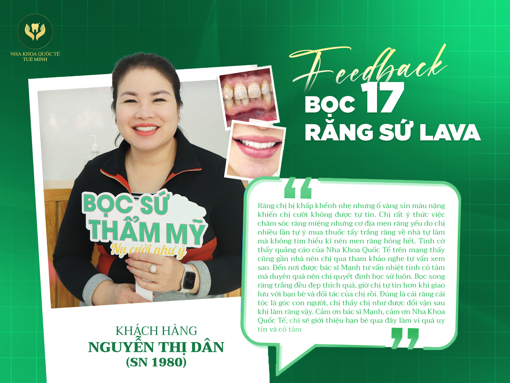 FEEDBACK BỌC 17 RĂNG SỨ LAVA