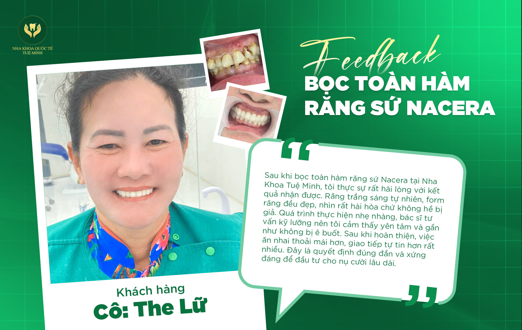 Feedback BỌC TOÀN HÀM RĂNG SỨ NACERA